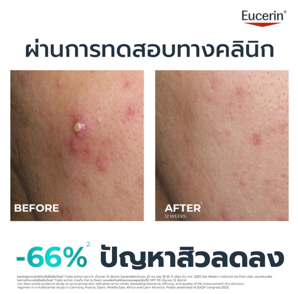 Eucerin DERMOPURE CLINICAL TRIPLE ACTION 40 ML